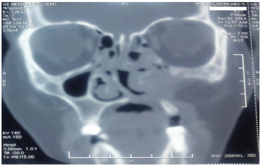 Nasogastric decompression procedure picture